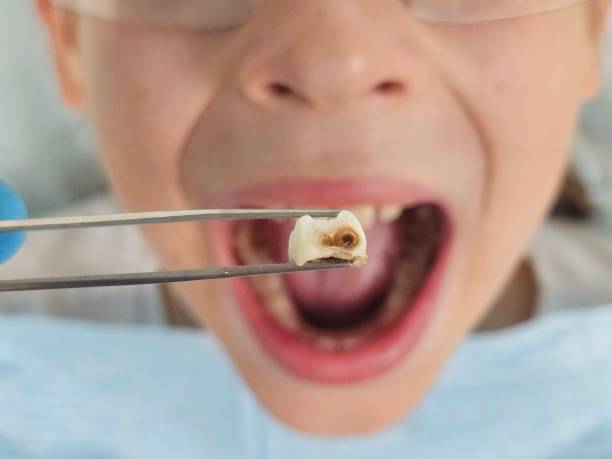 Best Emergency Tooth Extraction in Maquoketa, IA